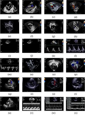 Standard Echocardiographic View Recognition in Diagnosis of Congenital Heart Defects in Children Using Deep Learning Based on Knowledge Distillation